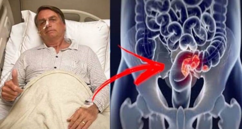 Após pressão nas redes sociais médicos revelam toda a verdade sobre saúde de Bolsonaro
