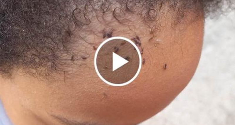 OLHA A QUANTIDADE DE PIOLHO QUE ESSA CRIANÇA DE 12 ANOS TEM