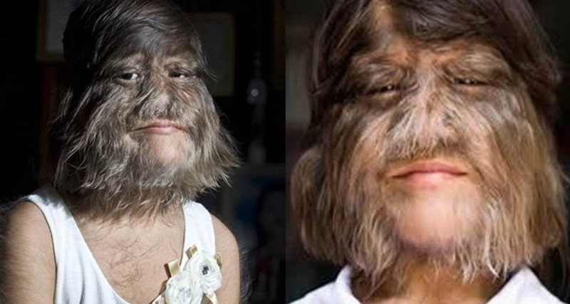 Lembra da garota mais peluda do mundo? Ela vai se casar e se depilou. Quando você ver como ela ficou vai ficar chocado