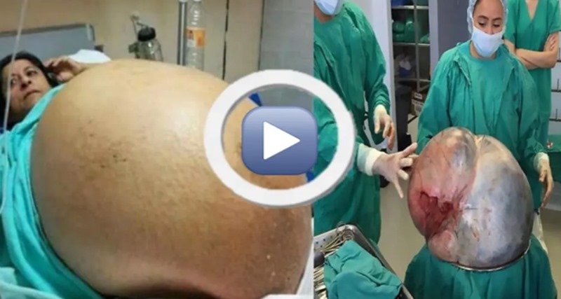 Você vai ficar chocado ao descobrir o quê os médicos retiraram da barriga dessa mulher – VÍDEO