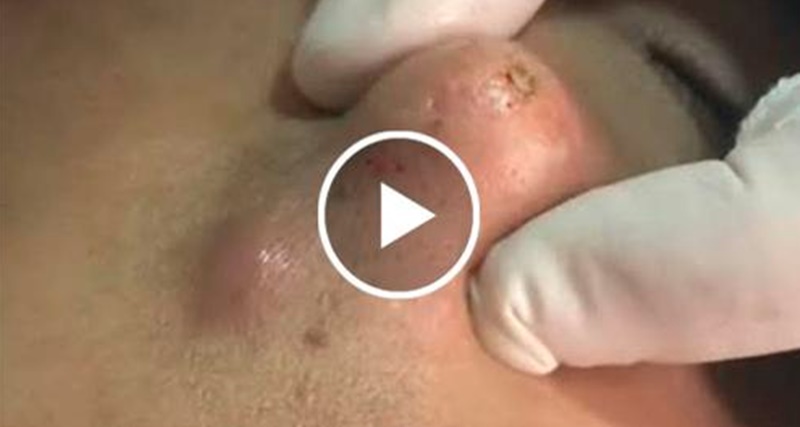 CRAVO GIGANTE, VEJA O QUE SAIU DE DENTRO ‘IMPRESSIONANTE’; VEJA O VÍDEO