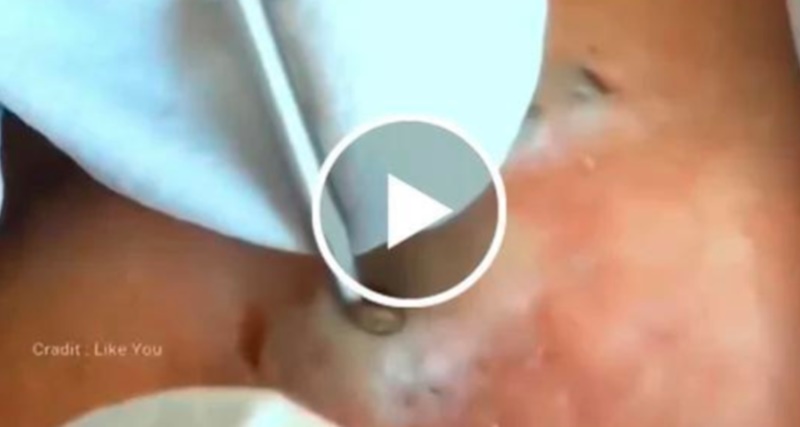 Cravo preto sendo removido, você não vai acreditar no que saiu de dentro; Veja o vídeo