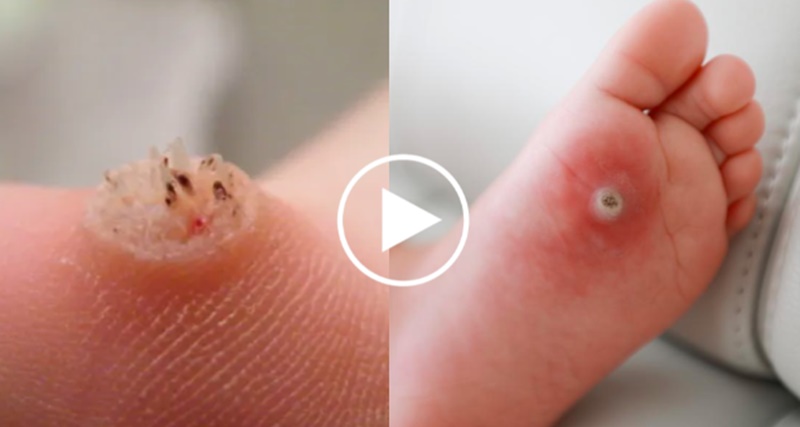 Olho de peixe: Veja como tirar com remédio caseiro e saiba quando pode ser PERIGOSO. “Acaba perdendo…”