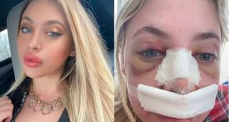 Durante cirurgia plástica, modelo descobre que dentro do seu nariz tinha um pedaço de co… ver mais