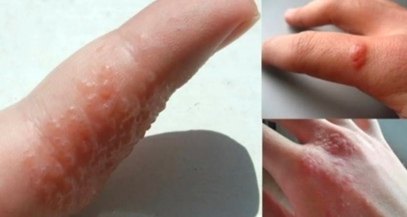 Se surgirem bolhas em suas mãos e pés, fique atento; pois pode ser sintomas de… Ver mais