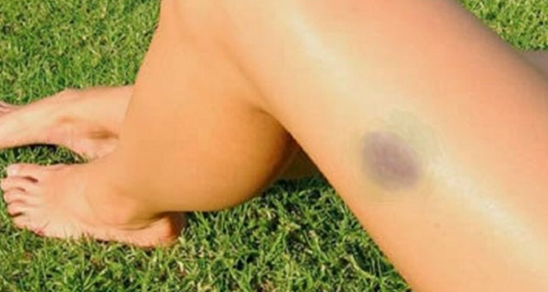 Médicos alertam: Manchas escuras que aparecem no corpo podem ser sinais de …ver mais