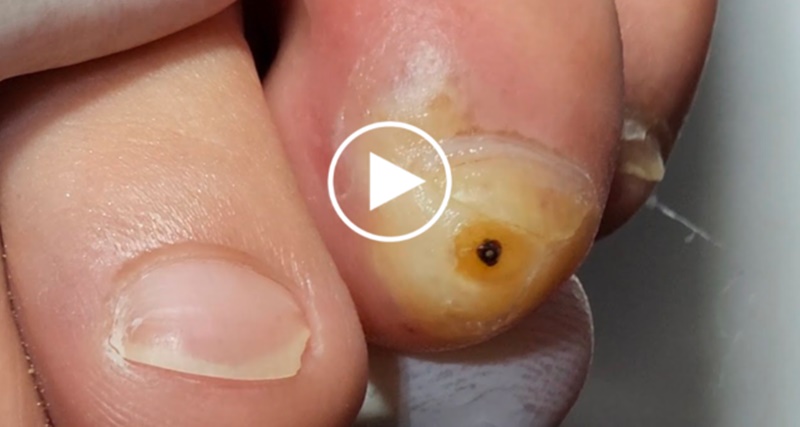 PARECE MENTIRA o que saiu dessa unha, ASSUSTADOR! – VEJA O VÍDEO