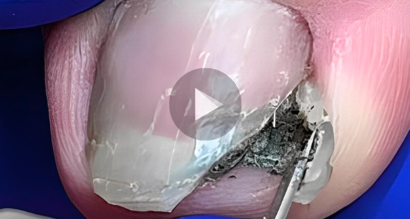 Olhe o que saiu dessa unha MEU DEUS, ASSISTA