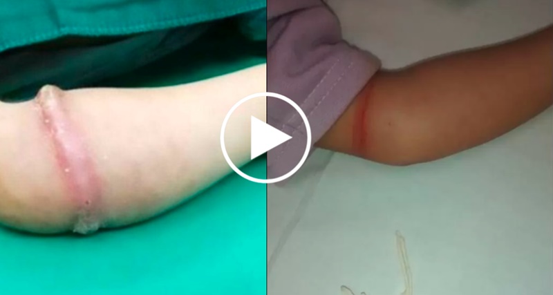 Médicos ficam ESPANTADOS com o que encontraram dentro do braço de uma menina de 4 anos: “Tinha…Ver mais