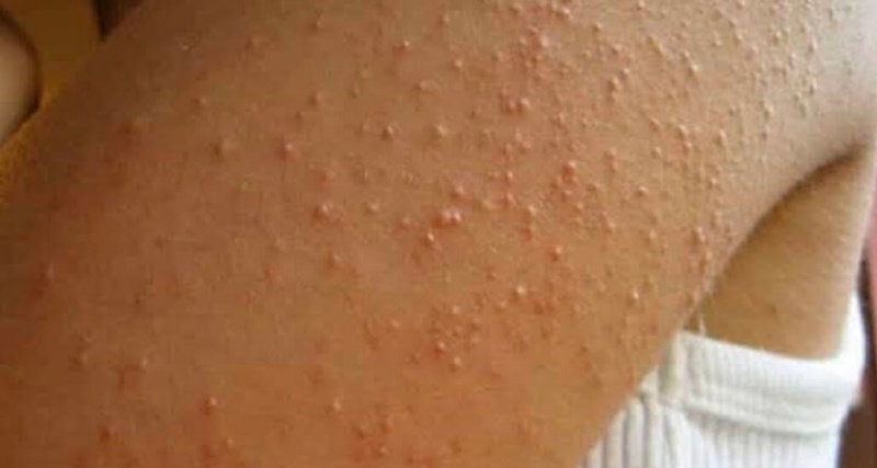 Aparecem essas bolinhas em seu braço? Então você precisa saber disso urgentemente