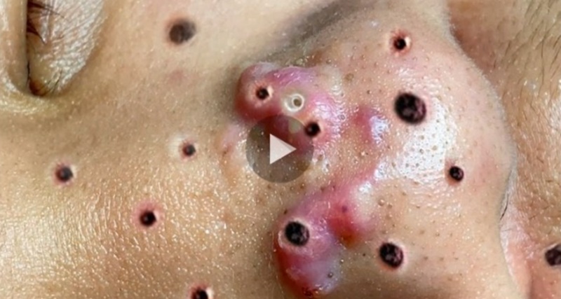 O QUE SAIU dessa ESPINHA parece mentira… VEJA O VÍDEO