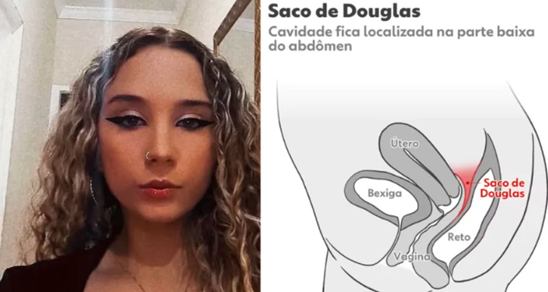 Saco De Douglas: Entenda O Que É A Região Citada No Atestado De Óbito De Jovem Que Teve Encontro Com Jogador. Ver Mais