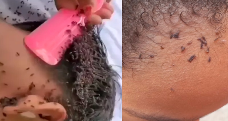 Menina de 4 anos tem CASO GRAVE de piolhos e seu estado de saúde é ASSUSTADOR: “Prestes à mor…Ver mais