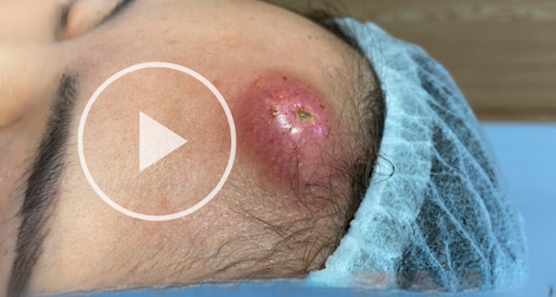 VEJA que IMPRESSIONANTE a retirada desse CRAVO GIGANTE