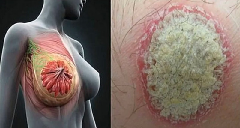 Fique atento aos 7 sinais, que o corpo avisa que pode estar com um câncer…Ver mais