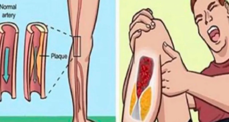ALERTA! 8 sinais que suas Artérias podem estar entupidas e você nem imaginava… VER MAIS