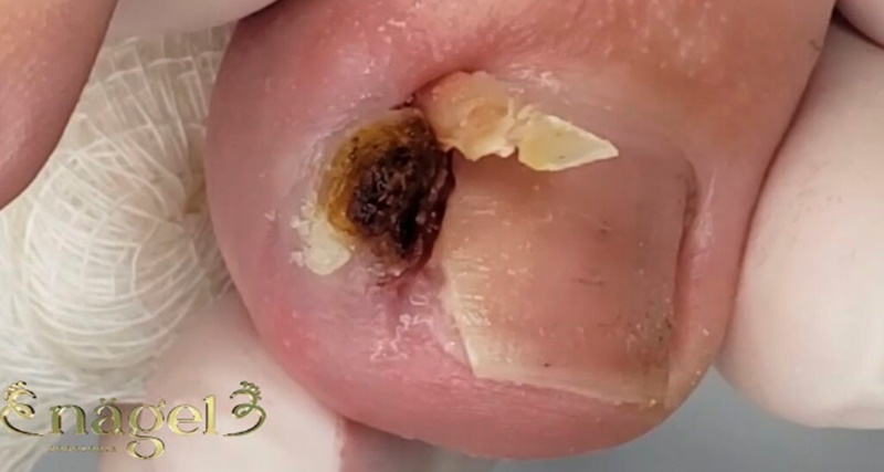 O que tinha dentro dessa unha é ASSUSTAD0R! Veja o vídeo