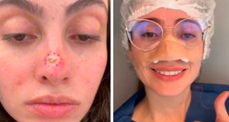 Ela Pensava Que Era Uma Espinha, E No Final Descobriu Que Era Um…Veja O Vídeo