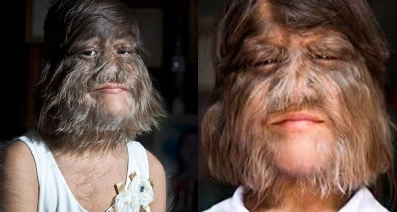 Lembra da garota mais peluda do mundo? Ela vai se casar e se depilou e hoje está assi…Ver mais