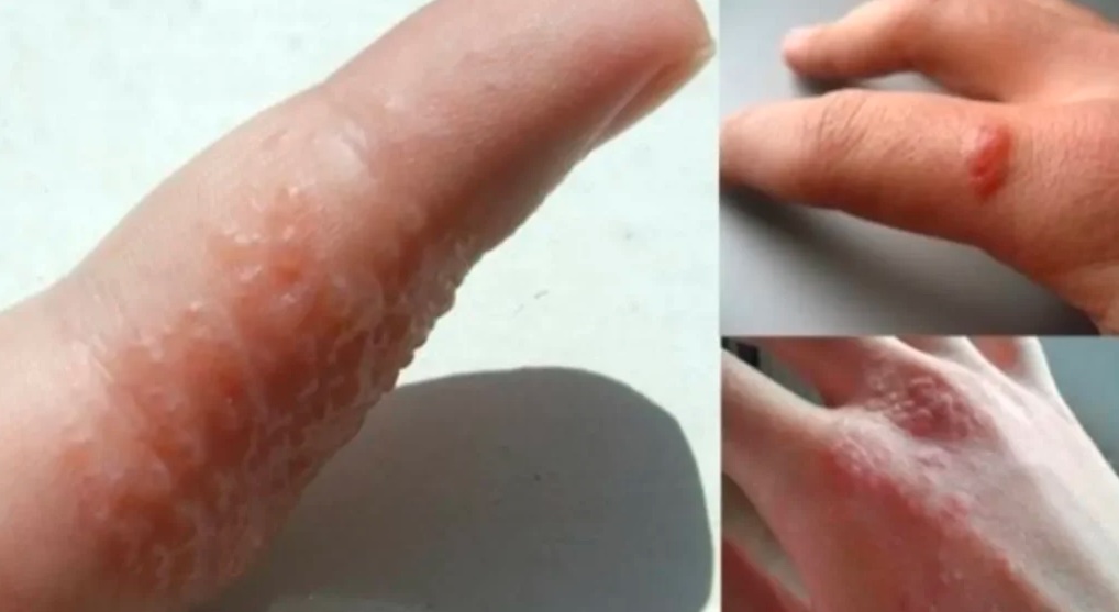ATENÇÃO! Se surgirem bolhas em suas mãos e pés pode ser sintomas de… ver mais