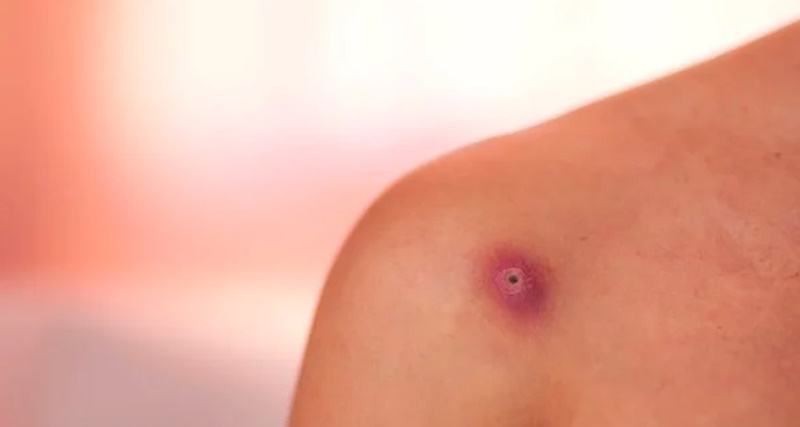 Ela pensou que era um TUM0R, mas o que saiu do braço dela foi um… Ver mais