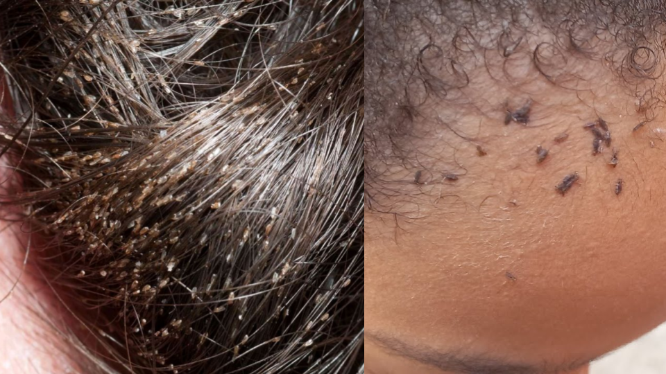 Menina CHORAVA de dor na cabeça, quando a mãe olhou o cabelo dela liga para a polícia IMEDIATAMENTE: “Tinha…Ver mais