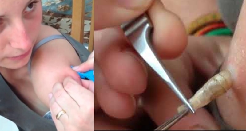 Meu Deus! Ela nem imaginava o que tinha dentro do seu braço – VÍDEO