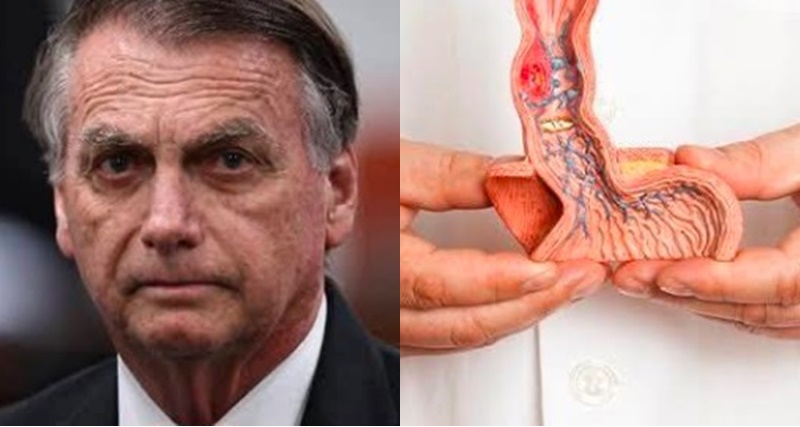 Verdadeiro quadro de saúde de Bolsonaro é revelado, infelizmente ele esta com… Ver mais
