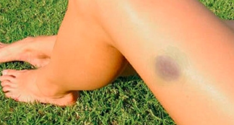 Médicos alertam: Manchas escuras que aparecem no corpo podem ser sinais de …ver mais