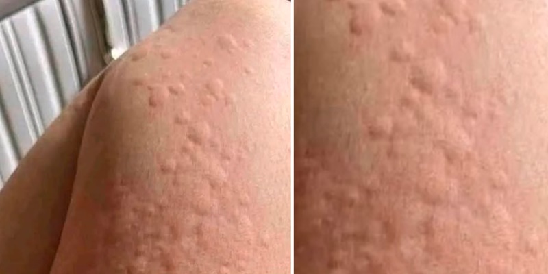 Se seu corpo coçar e aparecer essas bolinhas na sua pele, significa que…Ver Mais